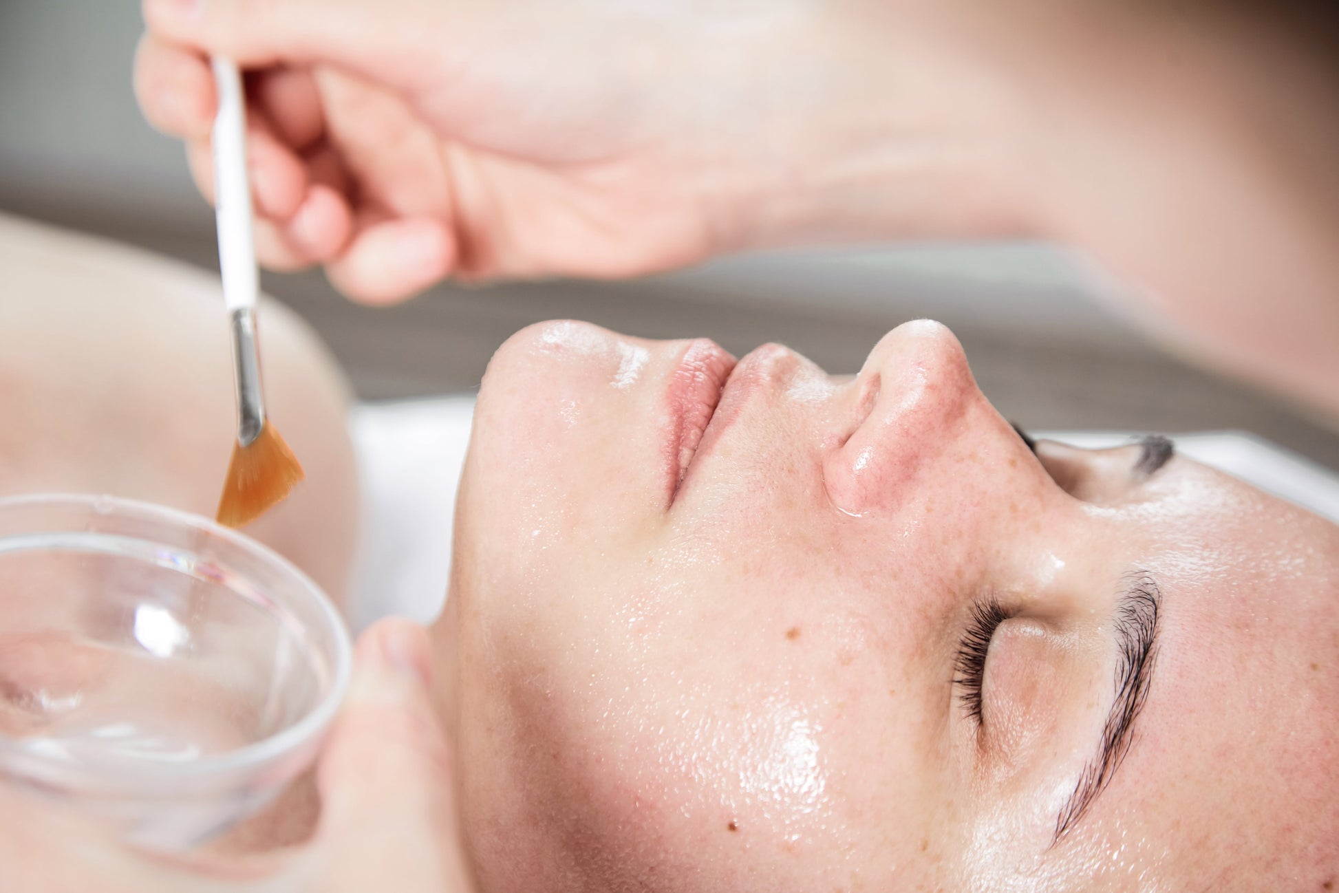 30% Glycolic Acid Peel - Chemical Peel