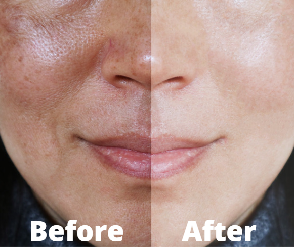 Bio Plasma Pen - Skin Care Device